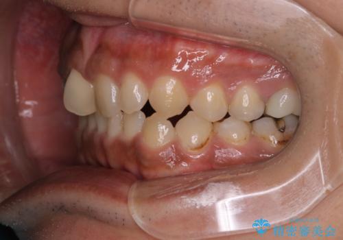 【モニター】インビザライン 前歯の捻れを治したいの治療前