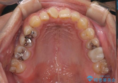 【モニター】インビザライン 前歯の捻れを治したいの治療前
