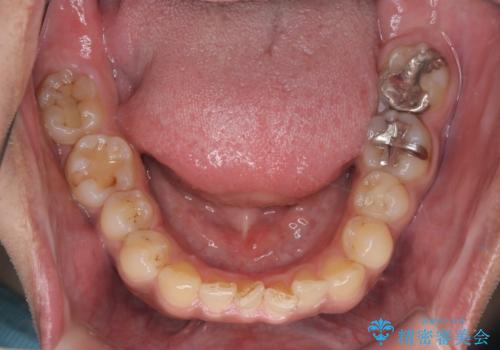 【モニター】インビザライン 前歯の捻れを治したいの治療前