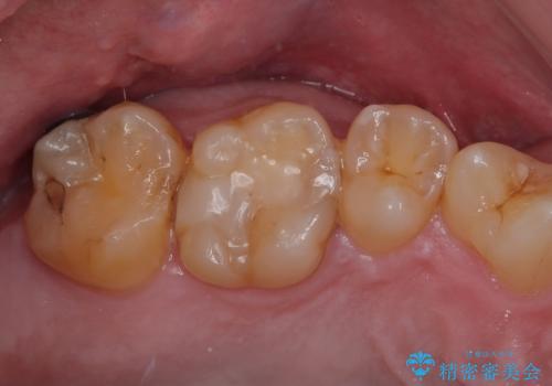 金属の詰め物がとれたので虫歯治療をしたい セラミックインレー修復の症例 治療前