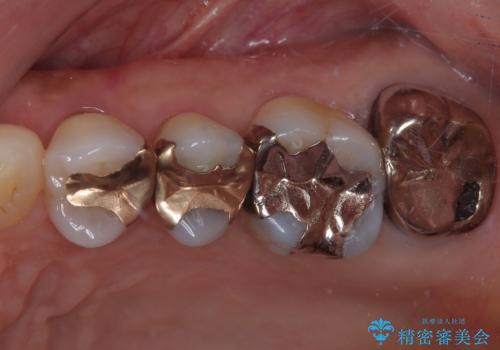 被せものに穴が開いたのでやり替えたい オールセラミッククラウンの症例 治療前