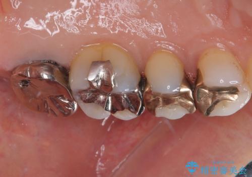 被せものに穴が開いたのでやり替えたい オールセラミッククラウンの治療前