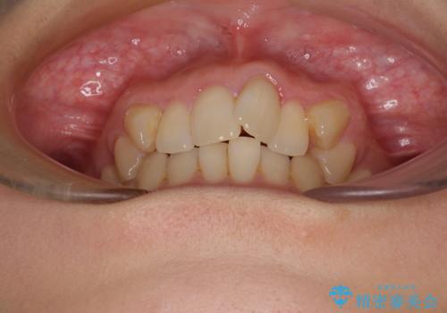 八重歯を改善 ワイヤー装置での抜歯矯正の治療前