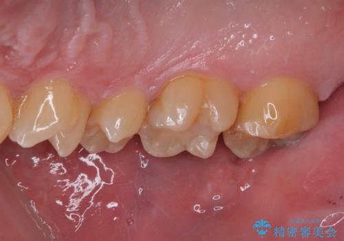 金属の詰め物がとれたので虫歯治療をしたい セラミックインレー修復の治療前