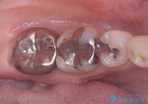 セラッミクインレー|オールセラミッククラウン|銀歯による二次カリエス|ラバーダムシート使用の治療前