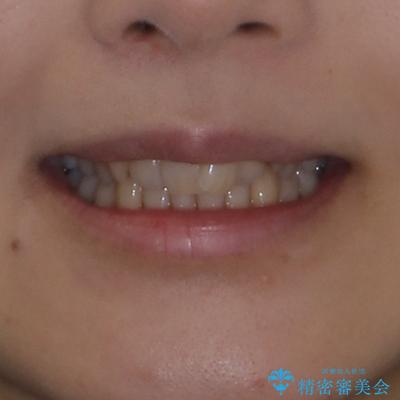 八重歯を改善 ワイヤー装置での抜歯矯正の治療前(顔貌)