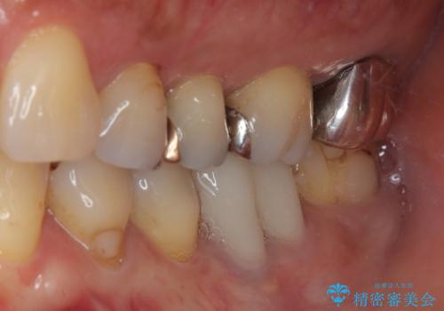 被せものに穴が開いたのでやり替えたい オールセラミッククラウンの治療前