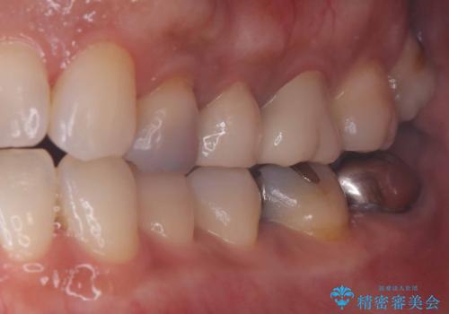 セラッミクインレー|オールセラミッククラウン|銀歯による二次カリエス|ラバーダムシート使用の治療前