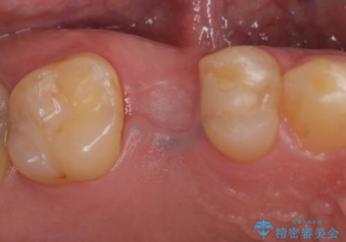 低侵襲なインプラント|痛くないインプラント|エンドペリオ病変|虫歯治療|セラッミクインレーの治療前