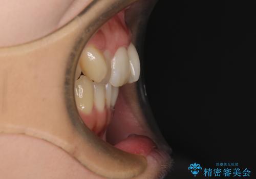 八重歯を改善 ワイヤー装置での抜歯矯正の治療前