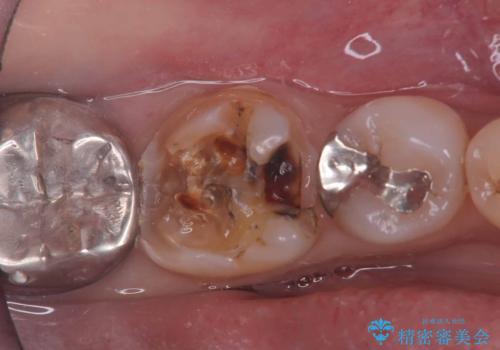 セラッミクインレー|オールセラミッククラウン|銀歯による二次カリエス|ラバーダムシート使用の治療前