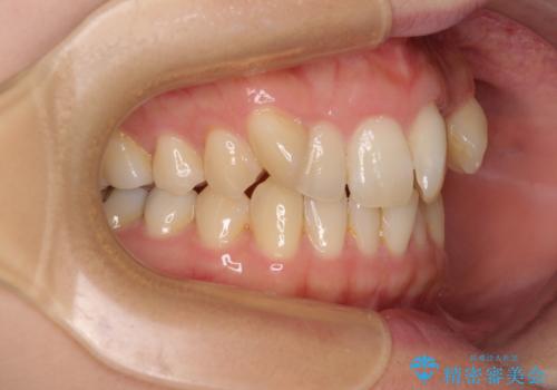 八重歯を改善 ワイヤー装置での抜歯矯正の治療前