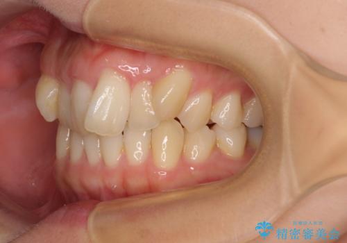 八重歯を改善 ワイヤー装置での抜歯矯正の治療前