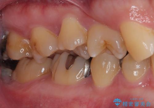 金属の詰め物がとれたので虫歯治療をしたい セラミックインレー修復の治療前