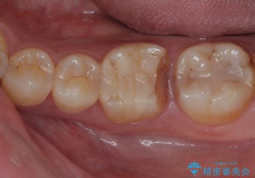 詰め物が割れたのでやり替えたい オールセラミッククラウンの症例 治療前