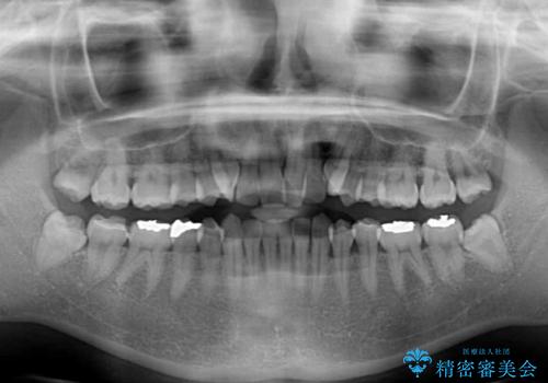 八重歯を改善 ワイヤー装置での抜歯矯正の治療前