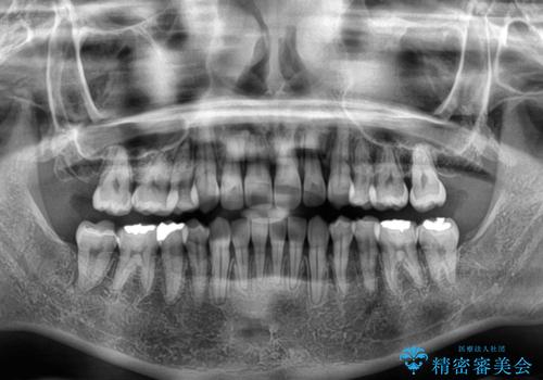 八重歯を改善 ワイヤー装置での抜歯矯正の治療後
