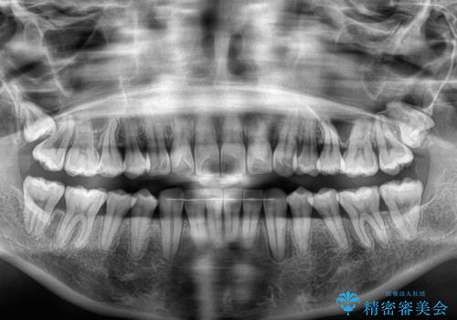 前歯のデコボコを治したい インビザライン矯正の治療後