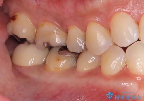銀歯の下の虫歯|オールセラミッククラウン|歯を長持ちさせるための治療|歯の神経を守るの治療後