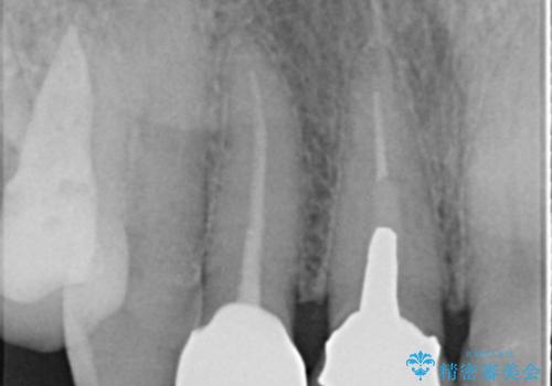 前歯を綺麗にしたい オールセラミッククラウンの治療後