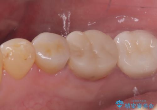 【セラミッククラウン】銀歯を白くしたいの治療後