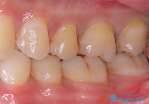 【セラミックインレー】虫歯がないか確認してほしいの治療前
