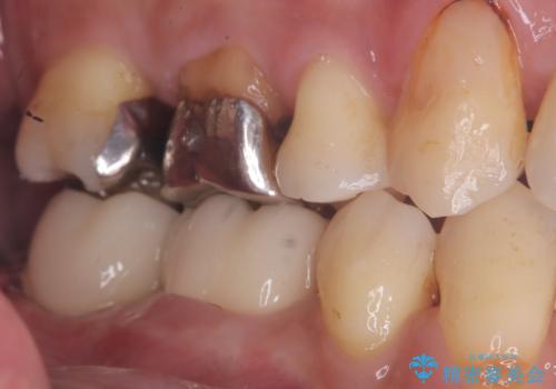 【セラミッククラウン】歯に穴が空いているの治療前