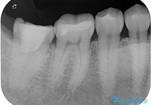 メタルフリー治療 虫歯になりにくいセラミックインレーへの治療後