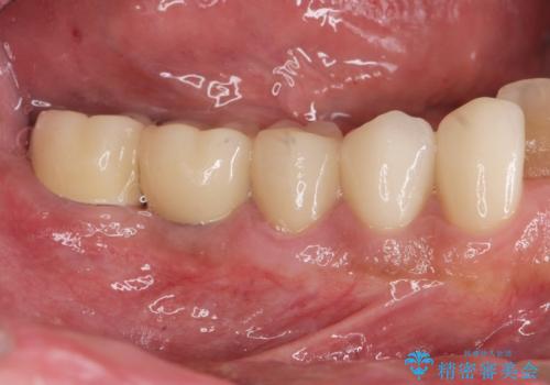 多数の銀歯と虫歯、セラミック・インプラント治療の症例 治療後