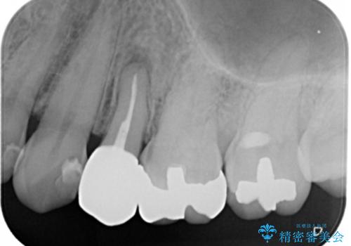 歯ぐきが腫れた フルジルコニアクラウンの治療後