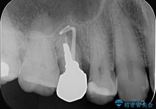 低侵襲なインプラント|痛くないインプラント|エンドペリオ病変|虫歯治療|セラッミクインレーの治療前