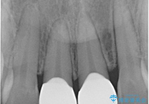 前歯を綺麗にしたい。の治療後