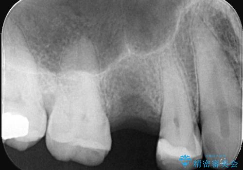 低侵襲なインプラント|痛くないインプラント|エンドペリオ病変|虫歯治療|セラッミクインレーの治療中
