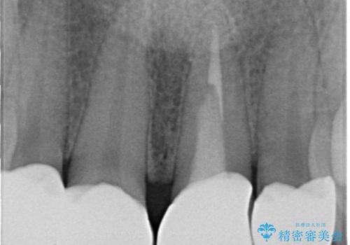 前歯の見た目を良くしたい オールセラミッククラウンの治療後