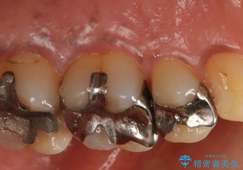 歯ぐきが腫れた フルジルコニアクラウンの治療前