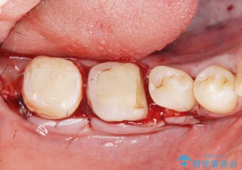 歯冠長延長術・骨隆起除去を行った、スペースの少ないセラミック治療の治療中
