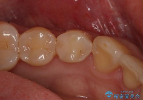 セラミックの被せ物を入れたい フルジルコニアクラウンの症例 治療前