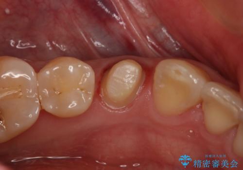 セラミックの被せ物を入れたい フルジルコニアクラウンの治療中