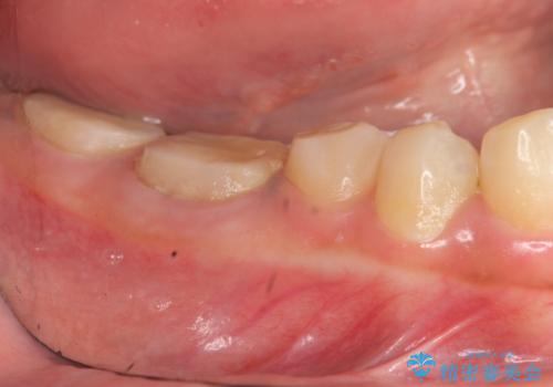 歯冠長延長術・骨隆起除去を行った、スペースの少ないセラミック治療の治療前