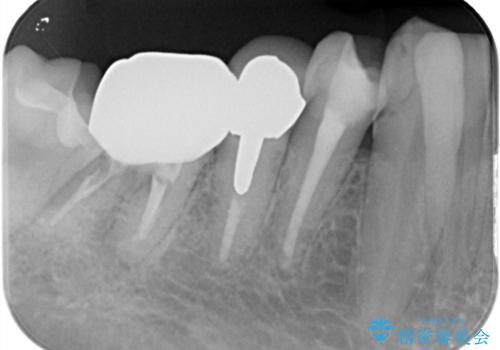 フロスがちぎれて取れない 他院の治療やり替え の治療前