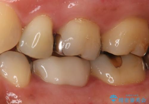 歯ぐきが腫れた フルジルコニアクラウンの治療前