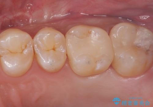 【セラミックインレー】虫歯がないか確認してほしいの症例 治療後