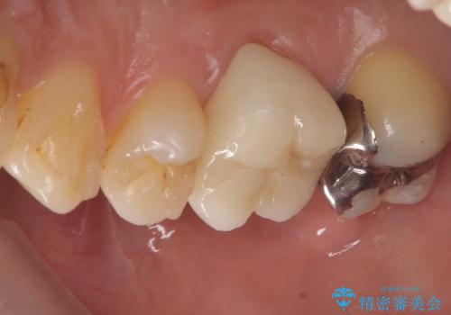 【セラミッククラウン】歯に穴が空いているの治療後