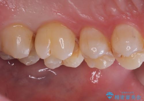 【セラミックインレー】虫歯がないか確認してほしいの治療中