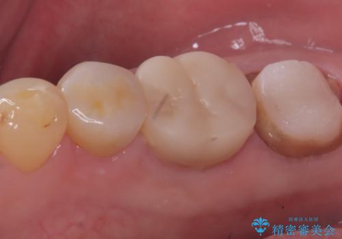 【セラミッククラウン】銀歯を白くしたいの治療中