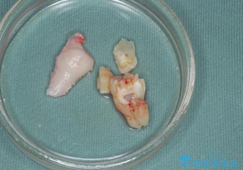 歯冠長延長術・骨隆起除去を行った、スペースの少ないセラミック治療の治療中