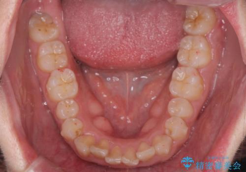 [ マウスピース矯正]  前歯のがたつき 出っ歯に見える歯をきれいに　の治療中