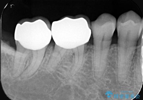 奥歯を美しくセラミック修復の治療後