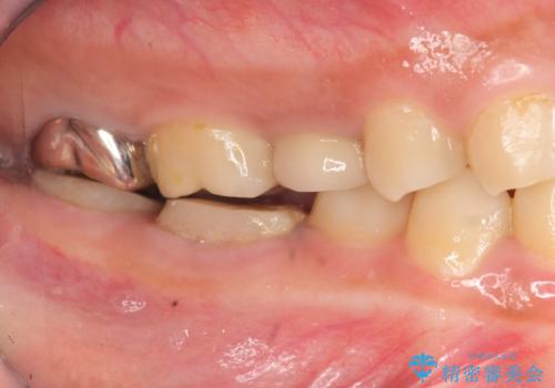 歯冠長延長術・骨隆起除去を行った、スペースの少ないセラミック治療の治療前