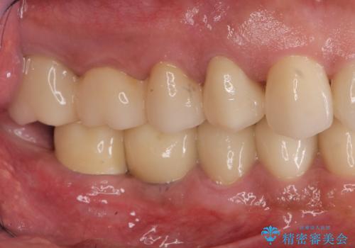 多数の銀歯と虫歯、セラミック・インプラント治療の治療後